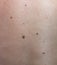 Close up the melanoma black spot on human skin.