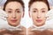 Close up middle age woman macro face before after collagen injection. Face lifting, anti aging concept. Plastic surgery, cosmetic