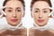 Close up middle age woman macro face before after collagen injection. Face lifting, anti aging concept. Plastic surgery, cosmetic