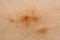 Close up of Molluscum Contagiosum also called water wart