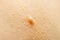 Close up of Molluscum Contagiosum also called water wart