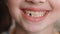Close-up mouth child has lost one milk teeth. Replacement of permanent changing teeth, toothless smile and hole in the