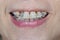 Close-up mouth of crooked teeth with braces