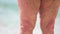 Close up obesed wrinkled legs of retired lady on the beach.