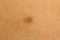 A close-up photo of the body with an extra nipple third nipple. Skin diseases, defects. Originality