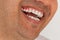 Close up photo of brown skinned young adult man with gum inflammation. Teeth care concept