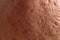 Close up photo of nodular cystic acne skin.