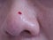 Close up picture of bleeding from popping blackheads on the nose. Problem of blackheads , whiteheads, uneven skin, pimples