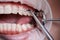 Close-up picture of mouth during dental procedure of removing rubber bands from brackets