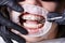 Close-up picture of mouth during dental procedure of removing rubber bands from brackets