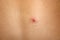 Close up of a pimple on the back