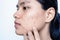 Close-up portrait of worried young Asian woman with acne problem on white background. Skin problem of the pimple