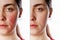 A close-up portrait of a young Caucasian woman showing redness and inflamed blood vessels on her cheeks. Isolate. Before and after