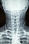 Close up x-ray film show cervical spine or c-spine, neck bones x-ray film.