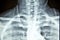 Close up x-ray film show cervical spine or c-spine, neck bones x-ray film.