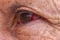 Close up of red eye or or bloodshot eyes which can be the sign of a minor irritation or a serious medical condition