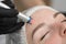 Close-up removal of blood vessels on the face of a diode laser in a cosmetic clinic. Therapist beautician makes a