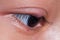 Close up right upper eye lid abscess