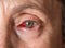 Close up of senior womans eye with conjunctivitis or pink eye around the iris