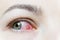 Close up of a severe bloodshot red eye. Viral Blepharitis, Conjunctivitis, Adenoviruses. Irritated or infected eye.