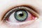 Close up of a severe bloodshot red eye. Viral Blepharitis, Conjunctivitis, Adenoviruses. Irritated or infected eye.