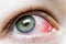 Close up of a severe bloodshot red eye. Viral Blepharitis, Conjunctivitis, Adenoviruses. Irritated or infected eye.