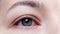 Close up of a severe bloodshot red eye. Viral Blepharitis, Conjunctivitis, Adenoviruses. Irritated or infected eye