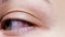 Close up of a severe bloodshot red eye. Viral Blepharitis, Conjunctivitis, Adenoviruses. Irritated or infected eye