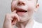 Close up shot of a baby boy teeth with caries. Health care, dental hygiene and childhood concept. Dental problems