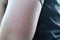 Close-up shot of scars, red, itchy rashes on arms of Asian women, skin disease or allergy concept.