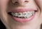 Close-up shot of teeth with braces. Female patient with metal brackets at the dental office. Orthodontic Treatment