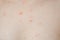 Close-up skin of adult woman affected by chickenpox, acne and dermatology