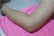 Close-up of the skin on the arm  Of women with skin diseases, allergies, rash, redness, itching, skin disease concepts