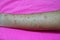 Close-up of the skin on the arm  Of women with skin diseases, allergies, rash, redness, itching, skin disease concepts