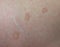 Close up skin disease Tinea versicolor/Pityriasis versicolor