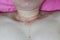 Close-up of the skin on the neck  Of women with skin diseases, allergies, rash, redness, itching, skin disease concepts