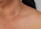 Close-up the skin tags on human skin, Asian woman middle age.