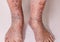 Close-up of skin with varicose veins