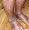 Close-up of skin with varicose veins