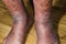 Close-up of skin with varicose veins