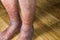 Close-up of skin with varicose veins