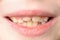 Close-up of a small boy with curved teeth smiling