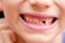 Close up smiling child mouth missing milk teeth