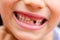 Close up smiling child mouth missing milk tooth