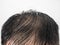 Close up Some hairstyles of many man serious hair loss problem for hair loss concept or health care shampoo product on white
