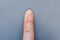 Close-up of a sore hand finger with a fungus on a gray background. Onycholysis: detachment of the nail from the nail bed