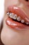 Close up of Sparkling Dental Braces on Teeth with Glossy Lips Orthodontic Beauty and Health Concept