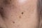 Close-up of spots and blackheads on the face