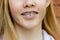 Close up of a teenage girl wearing metal braces. Orthodontic dental braces teeth straighteners. Gap between front teeth