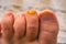 Close up of toe nails with one fungus infected nail, Common disease and infections